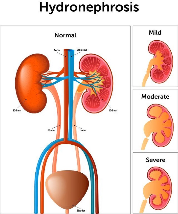 Swollen Kidney: Warning Signs To Watch Out For, Major Causes, And Treatment Options