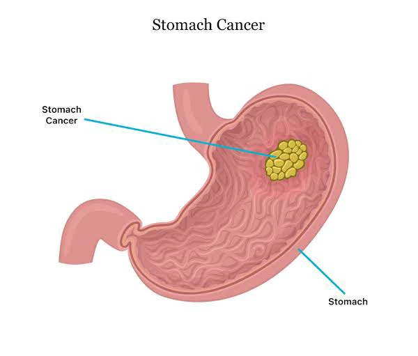 4 Things You Should Avoid To Reduce The Risk Of Stomach Cancer