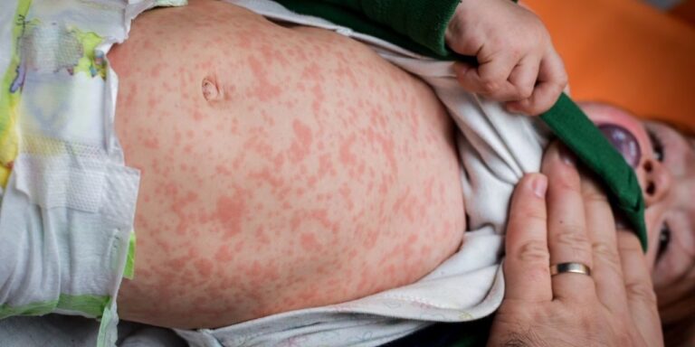 Measles Virus Alert in Quebec!